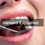 Vaneers Explained